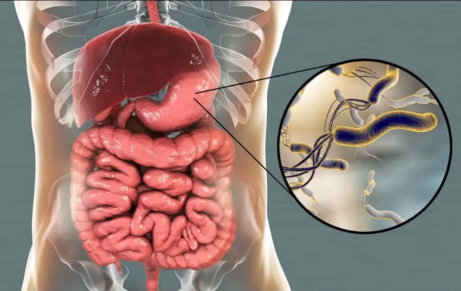 Helicobacter pylori