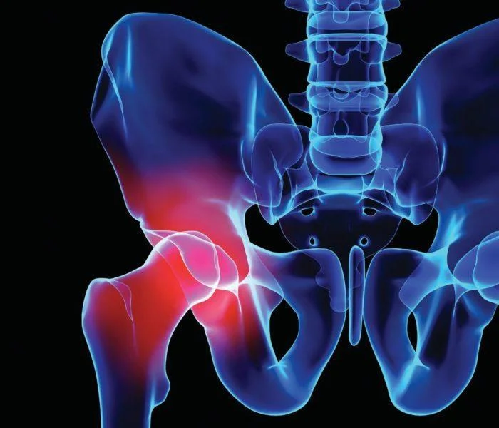 Photo of Surgical treatment of coxarthrosis 1