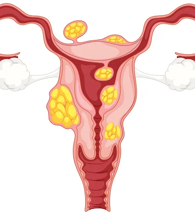 Photo of Uterine fibroids 3