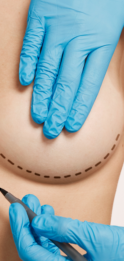 Mammoplasty 2