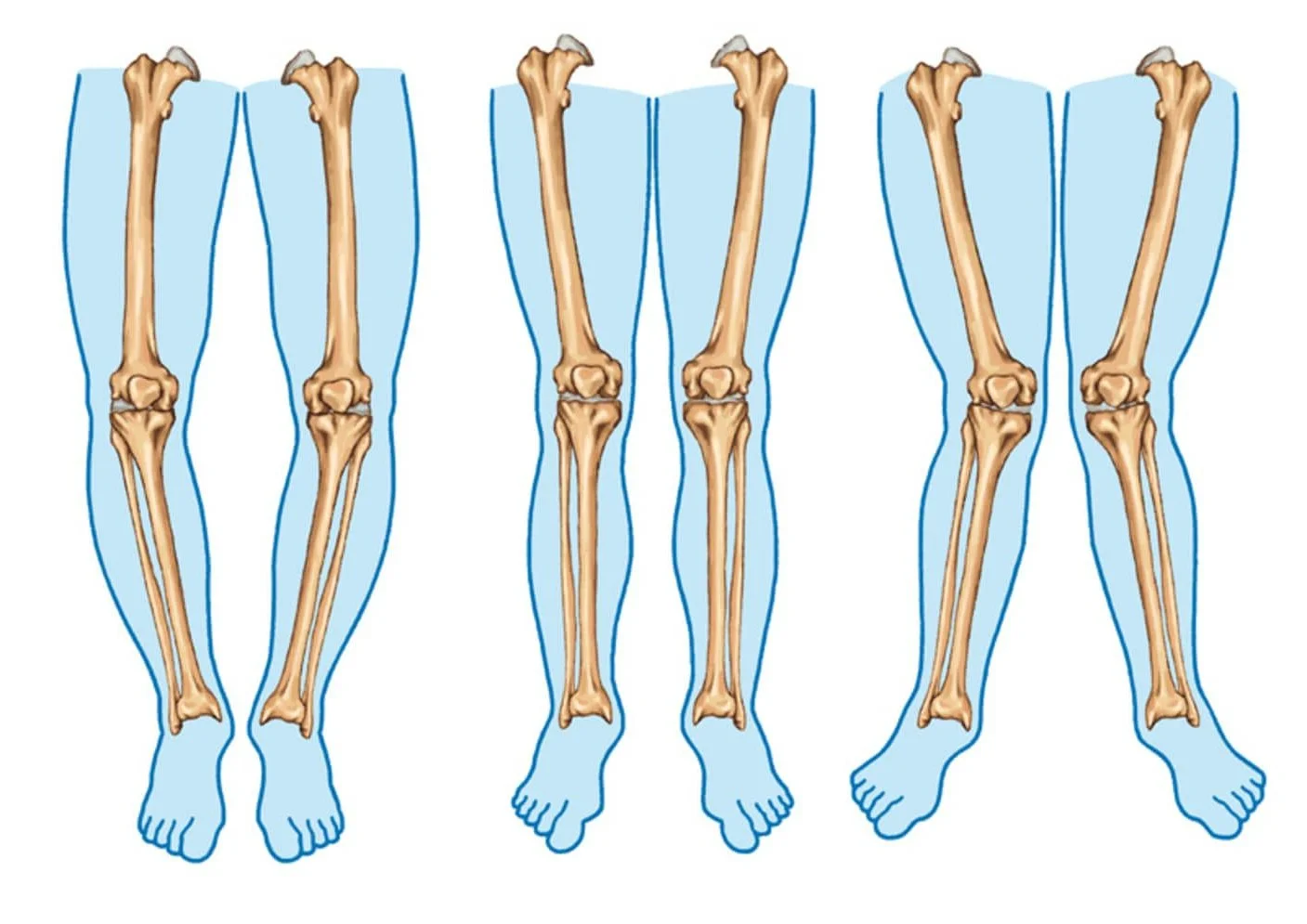 Photo of Osteotomy 4