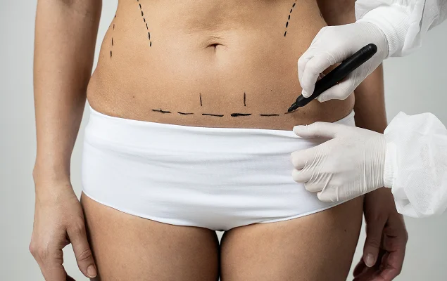 Photo of Mini-Abdominoplasty with Liposuction 1
