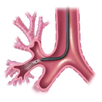 Photo of Bronchoscopy 3