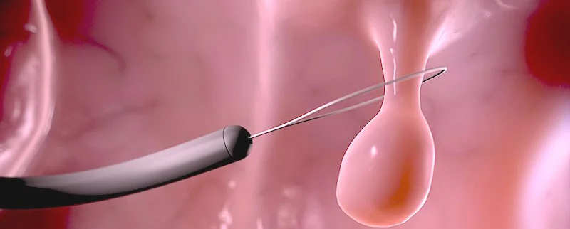 Photo of Removal of rectal polyps 4