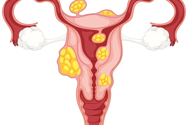 Photo of Uterine fibroids 5