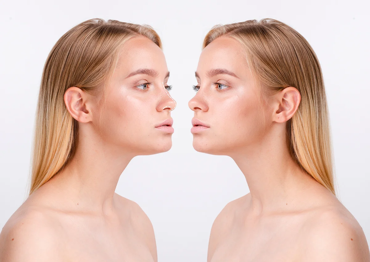Photo of Rhinoplasty 1