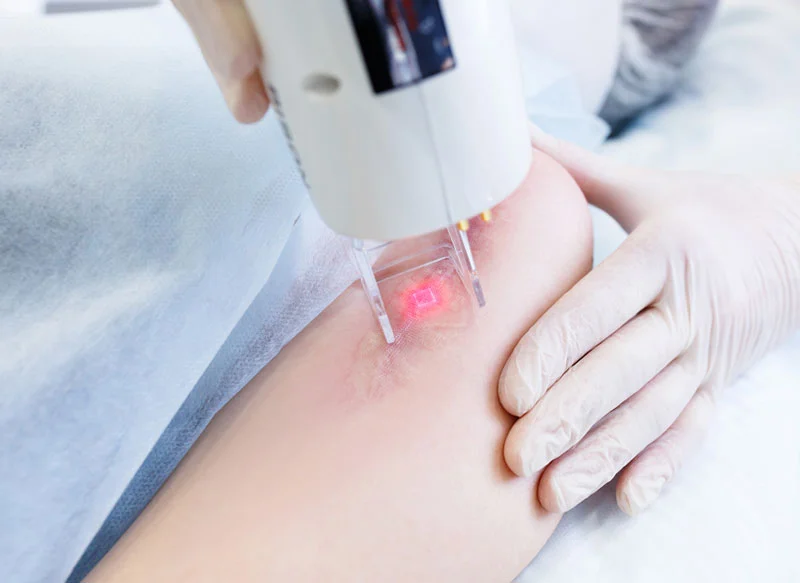 Photo of Surgical correction of scars 4