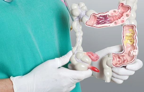 Photo of Removal of rectal polyps 5