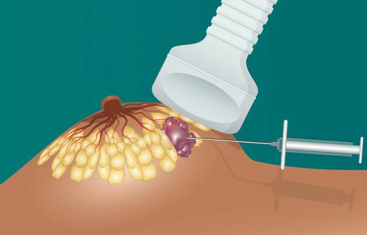 Photo of Core Needle Biopsy 4