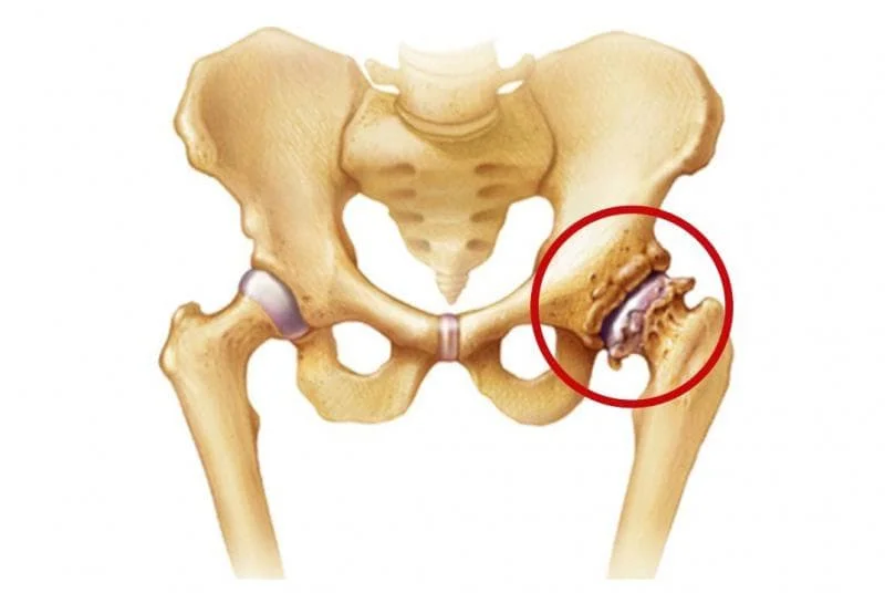 Photo of Surgical treatment of coxarthrosis 4