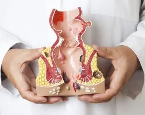 Photo of Removal of haemorrhoids 1